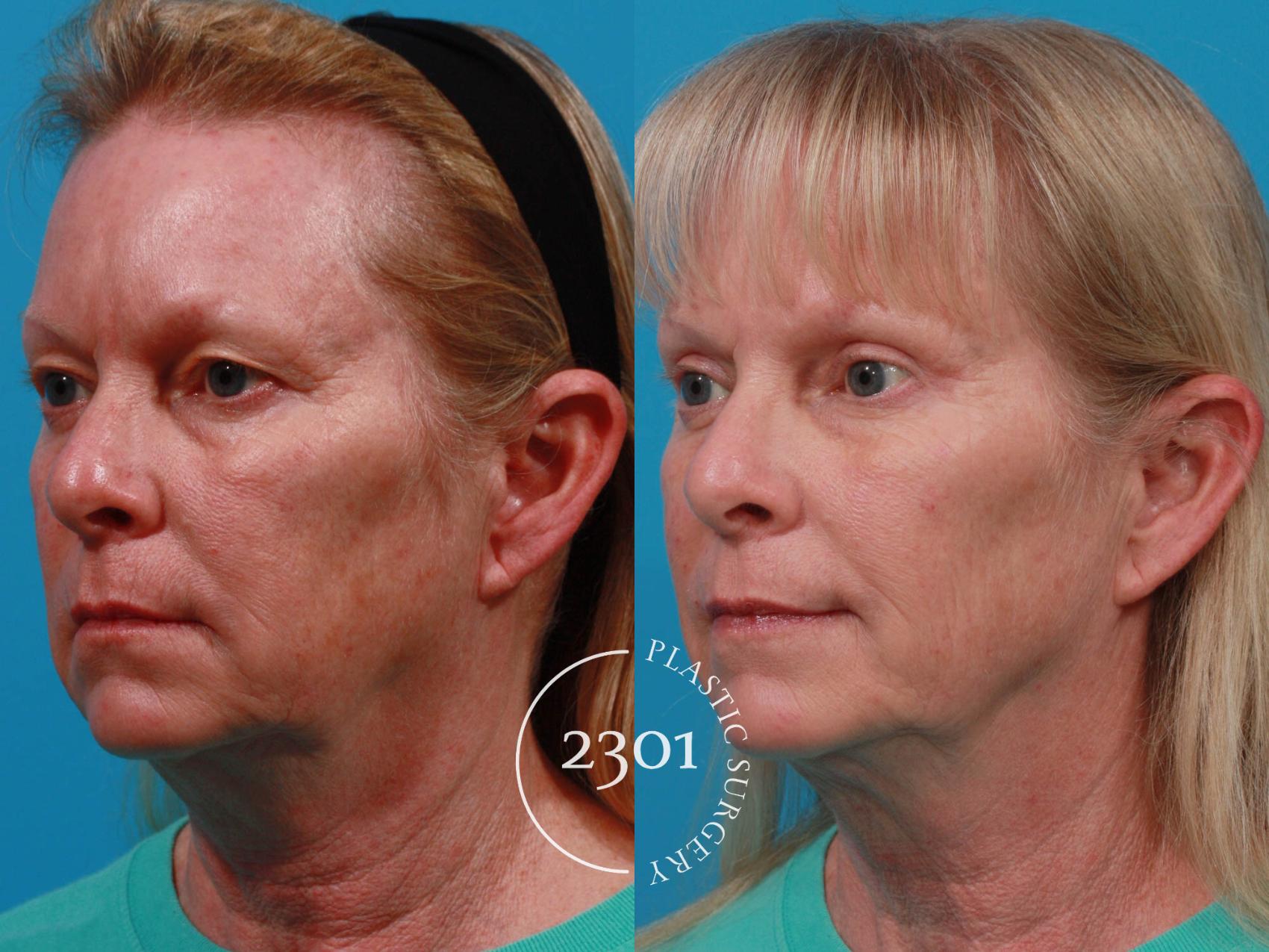 Before & After Eyelid Surgery (Upper) Case 725 Left Oblique View in Fort Worth, Plano, & Frisco, Texas