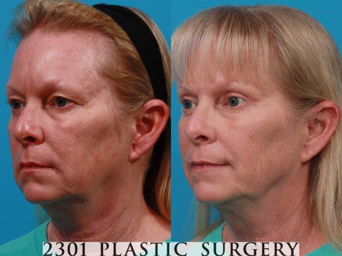 Before & After Eyelid Surgery (Upper) Case 725 Left Oblique View in Fort Worth, Plano, & Frisco, Texas