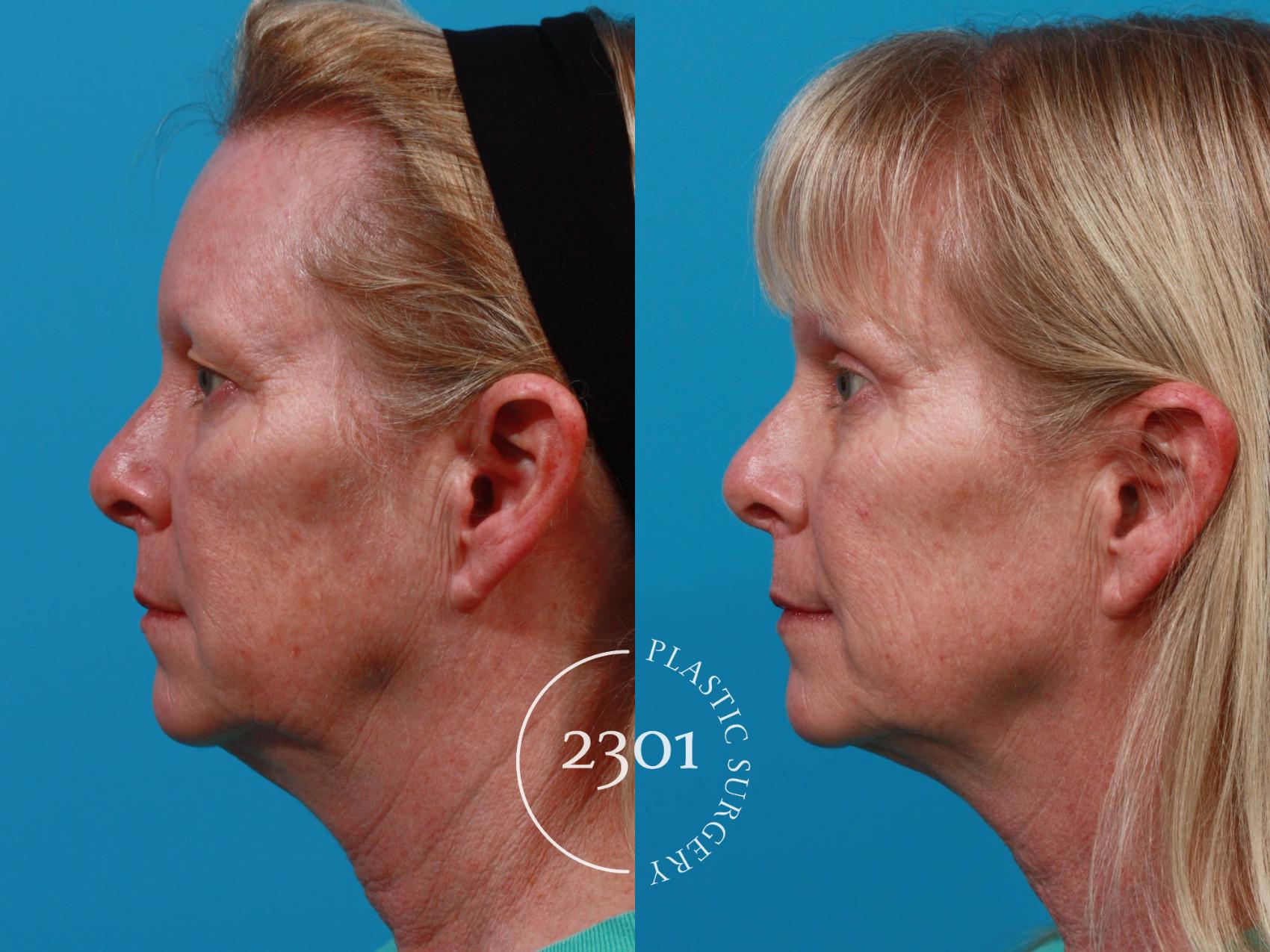 Before & After Eyelid Surgery (Upper) Case 725 Left Side View in Fort Worth, Plano, & Frisco, Texas