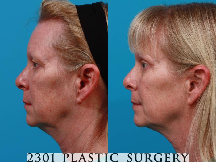 Before & After Eyelid Surgery (Upper) Case 725 Left Side View in Fort Worth, Plano, & Frisco, Texas