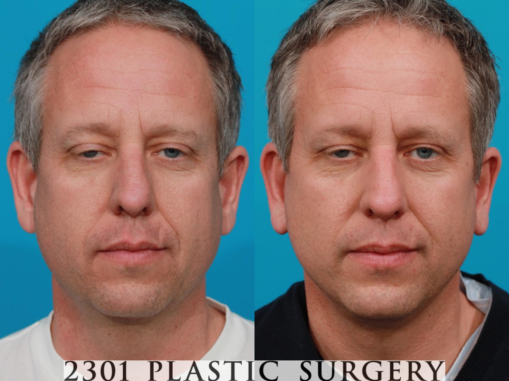 Before & After Face Lift Case 118 View #1 View in Fort Worth & Frisco, Texas