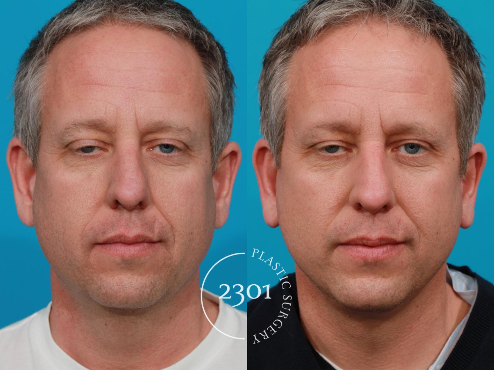 Before & After Male Face Lift Case 118 View #1 View in Fort Worth, Plano, & Frisco, Texas