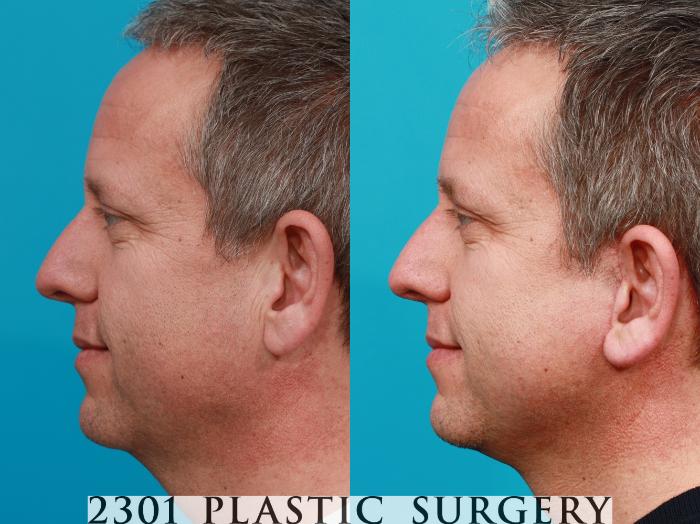 Before & After Face Lift Case 118 View #2 View in Fort Worth, Plano, & Frisco, Texas