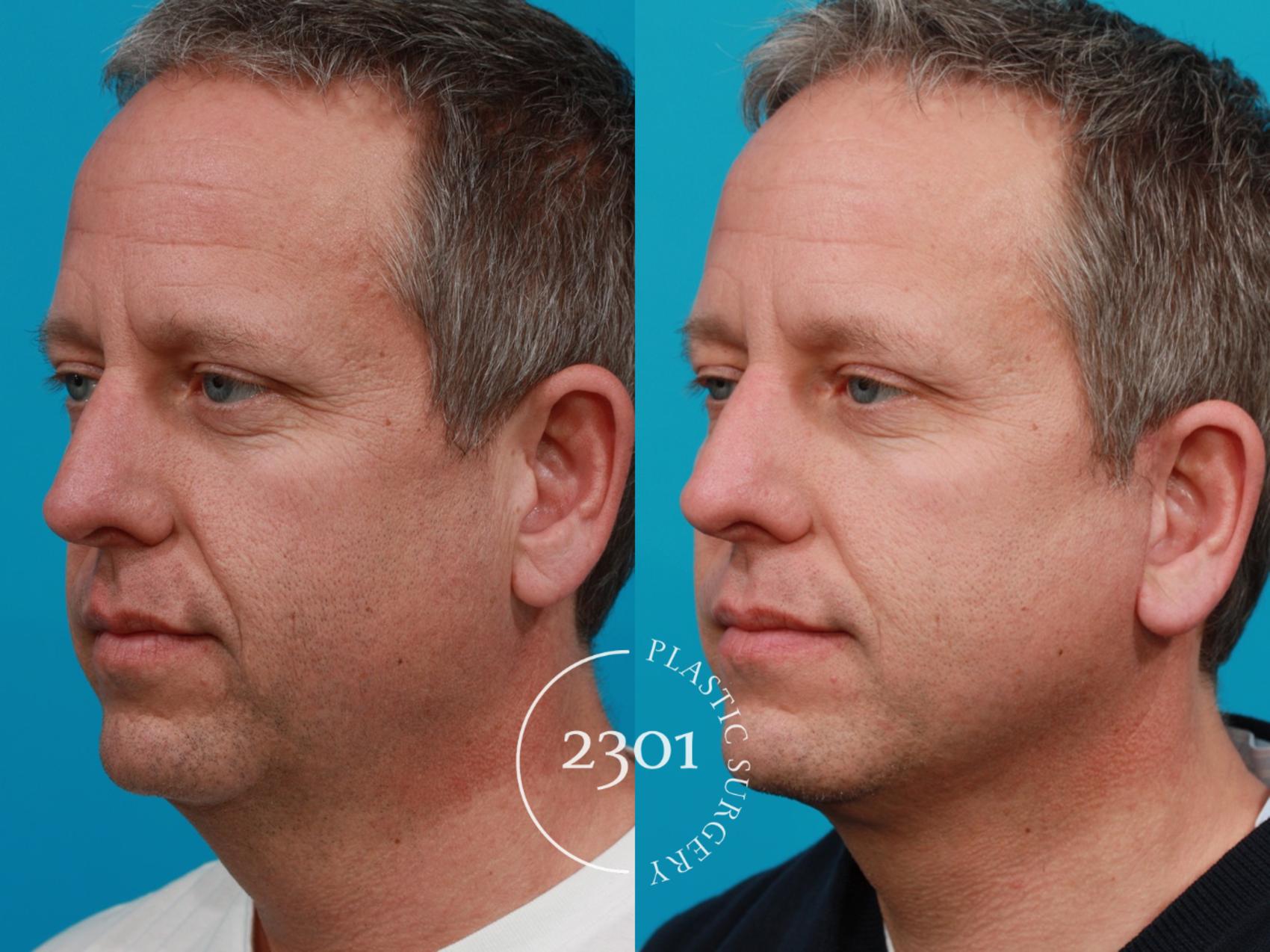 Before & After Neck Lift Case 118 View #3 View in Fort Worth, Plano, & Frisco, Texas