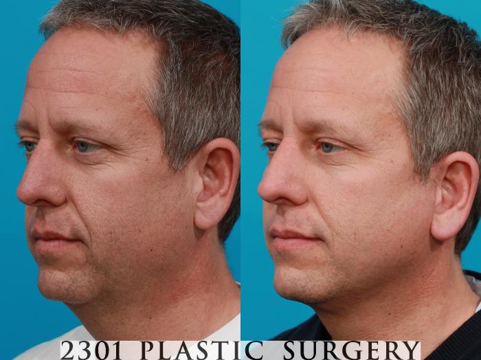 Before & After Male Face Lift Case 118 View #3 View in Fort Worth, Plano, & Frisco, Texas