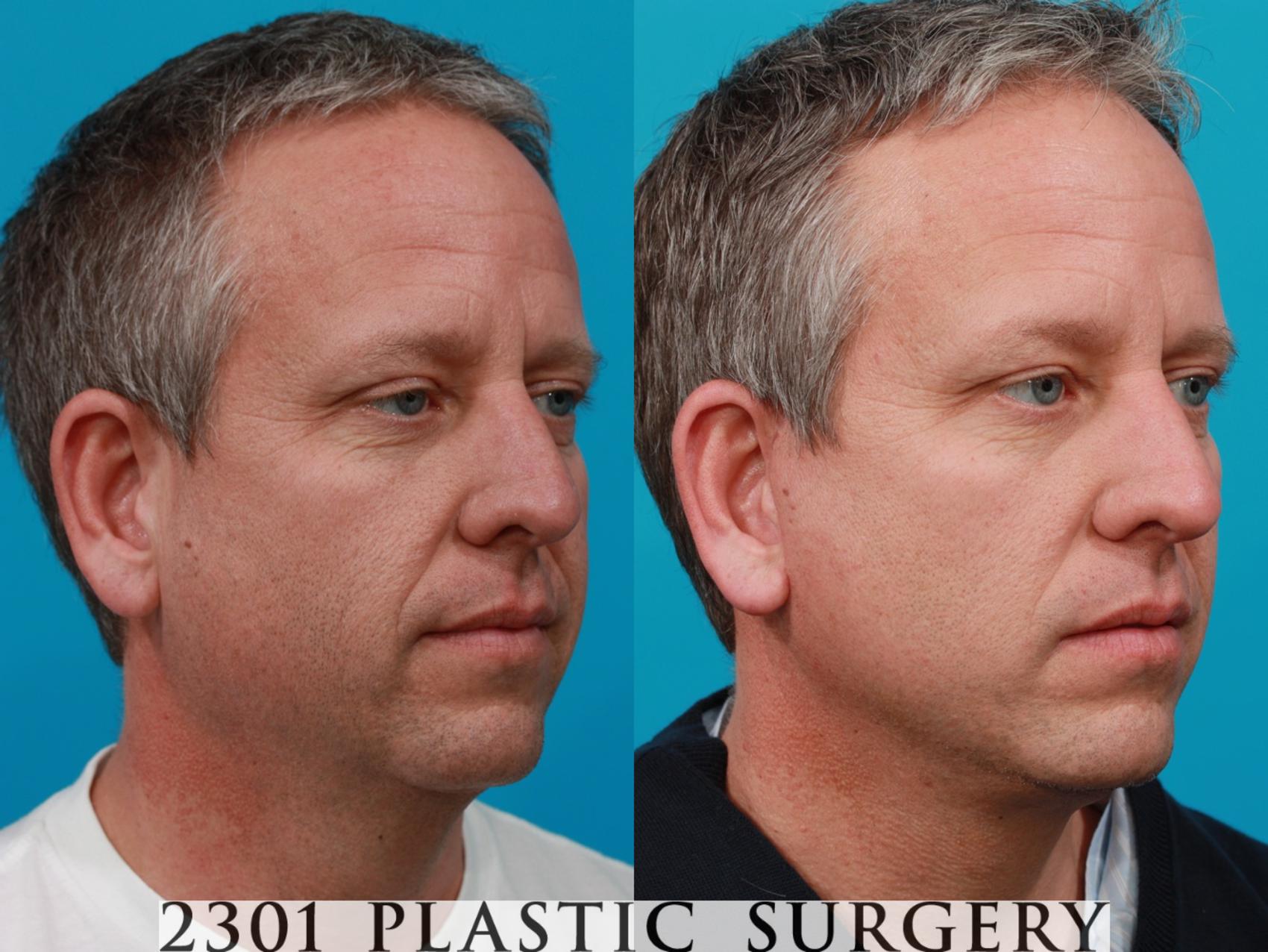 Before & After Face Lift Case 118 View #4 View in Fort Worth & Frisco, Texas