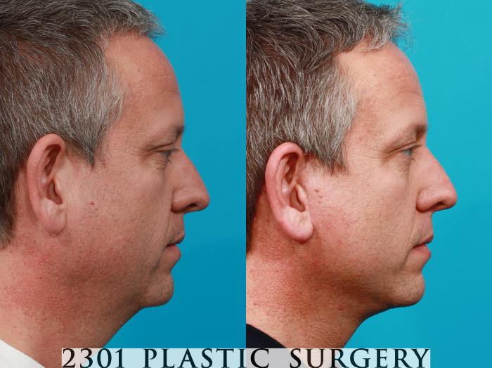 Before & After Face Lift Case 118 View #5 View in Fort Worth, Plano, & Frisco, Texas