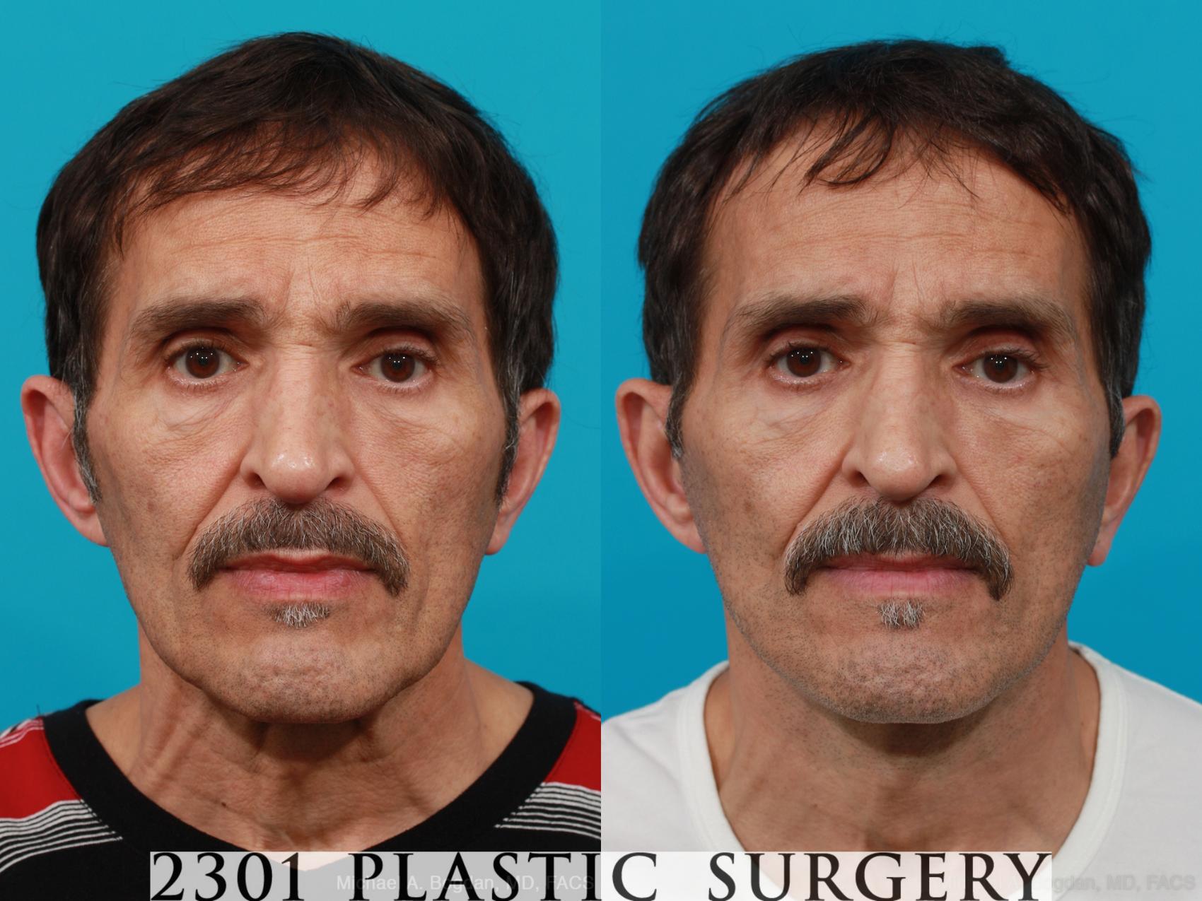 Before & After Face Lift Case 214 View #1 View in Fort Worth & Frisco, Texas