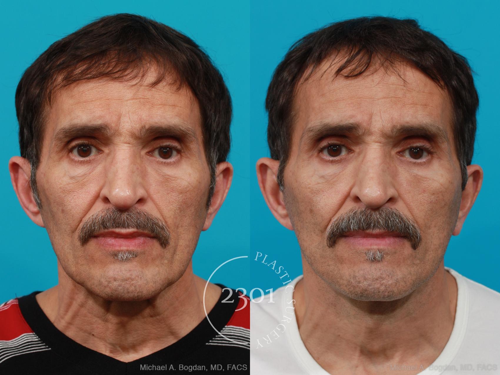 Before & After Face Lift Case 214 View #1 View in Fort Worth, Plano, & Frisco, Texas