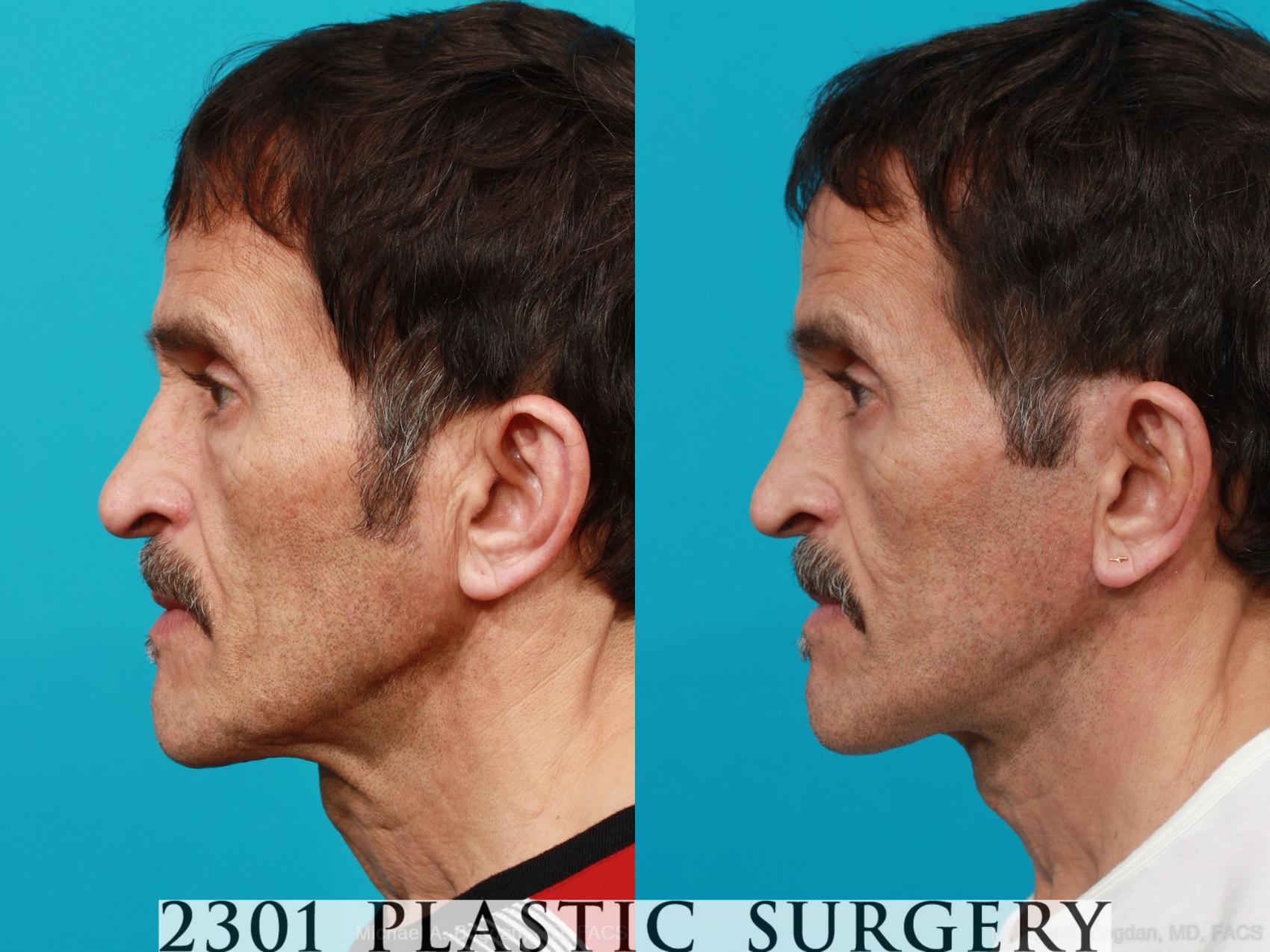 Before & After Face Lift Case 214 View #2 View in Fort Worth & Frisco, Texas