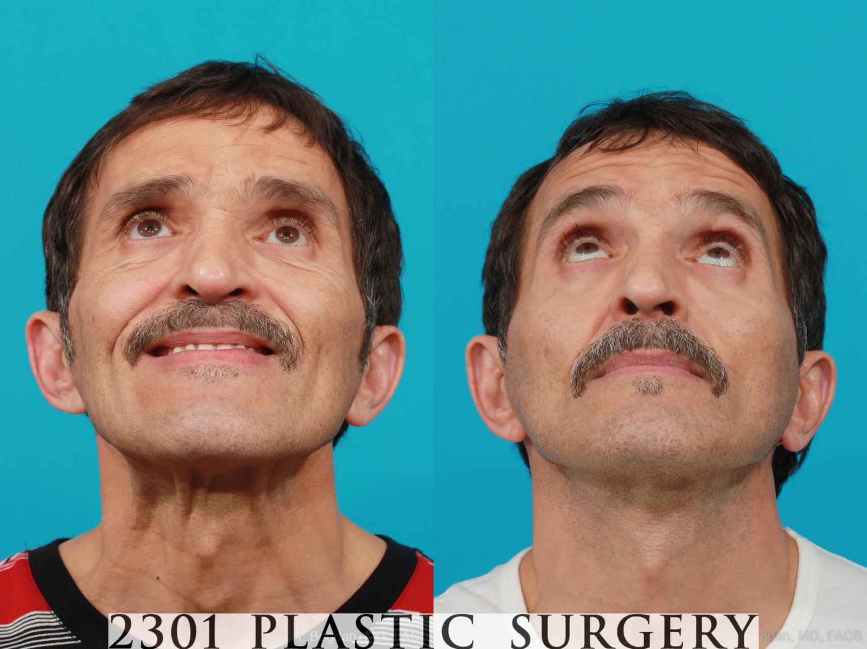 Before & After Face Lift Case 214 View #3 View in Fort Worth & Frisco, Texas