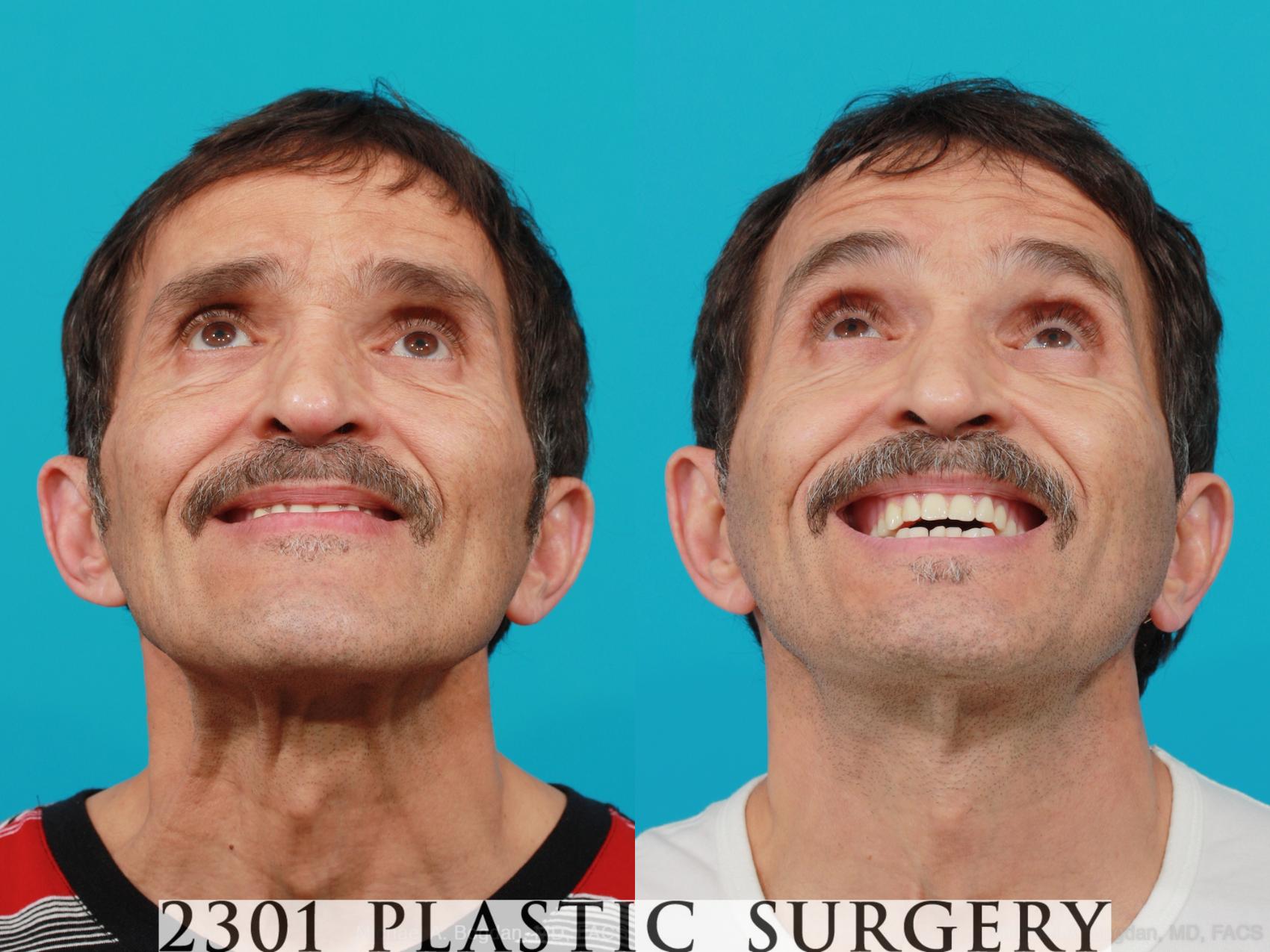Before & After Face Lift Case 214 View #4 View in Fort Worth & Frisco, Texas