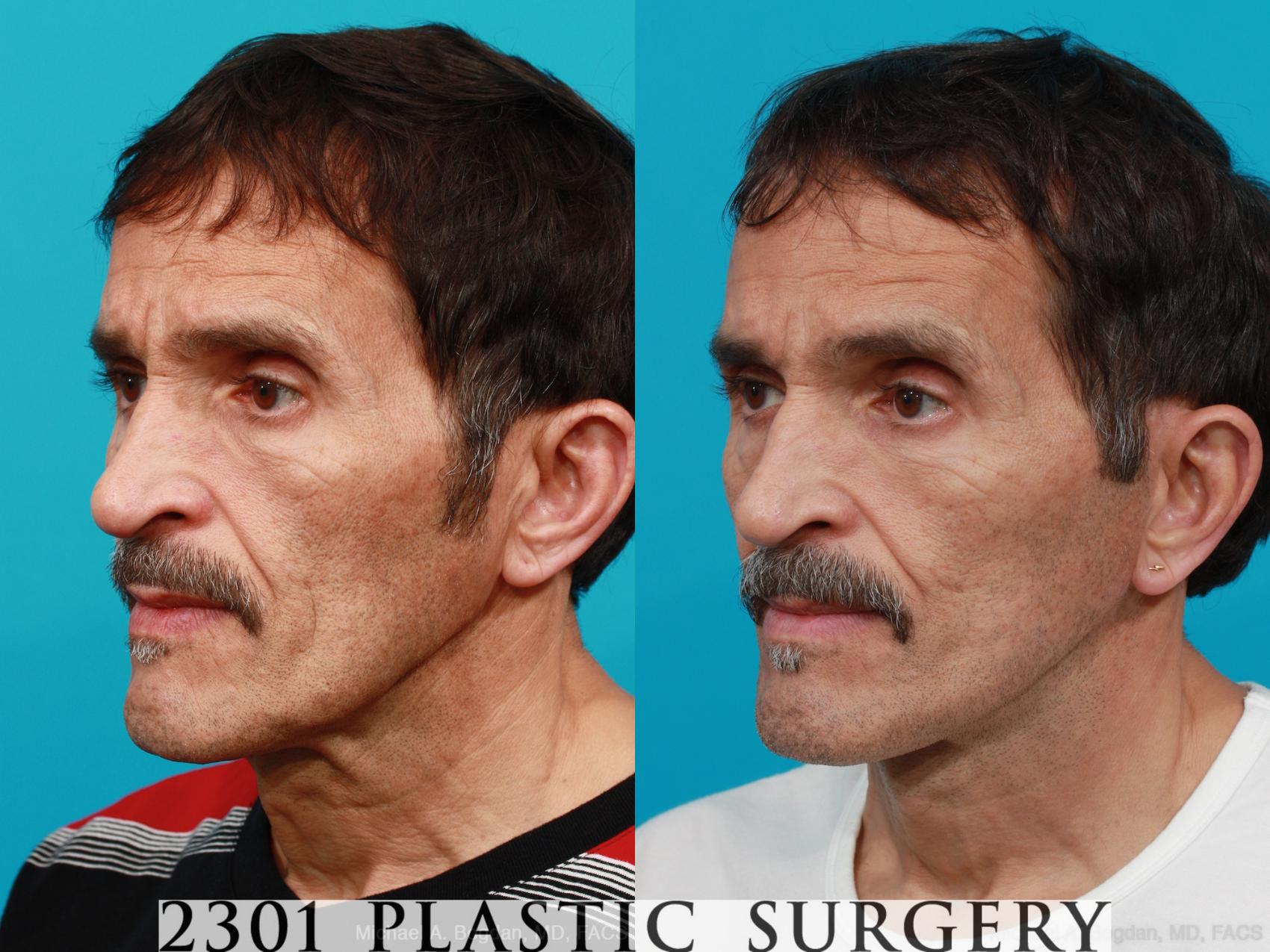 Before & After Face Lift Case 214 View #5 View in Fort Worth & Frisco, Texas