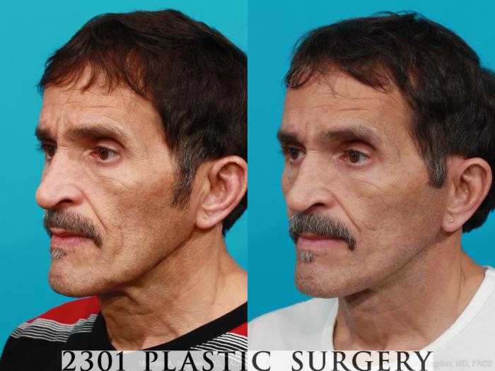 Before & After Face Lift Case 214 View #5 View in Fort Worth, Plano, & Frisco, Texas