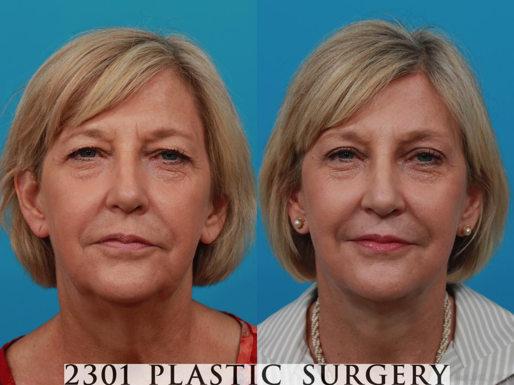Before & After Blepharoplasty Case 260 View #1 View in Fort Worth & Frisco, Texas