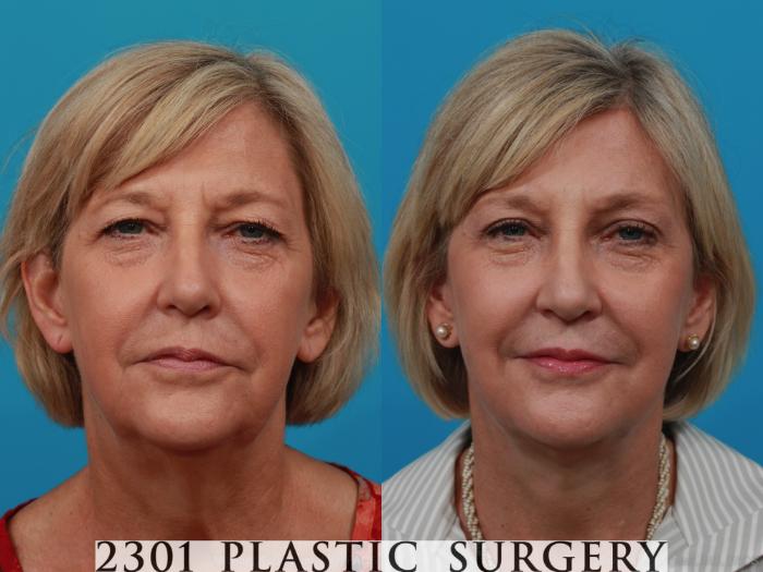 Before & After Blepharoplasty Case 260 View #1 View in Fort Worth, Plano, & Frisco, Texas