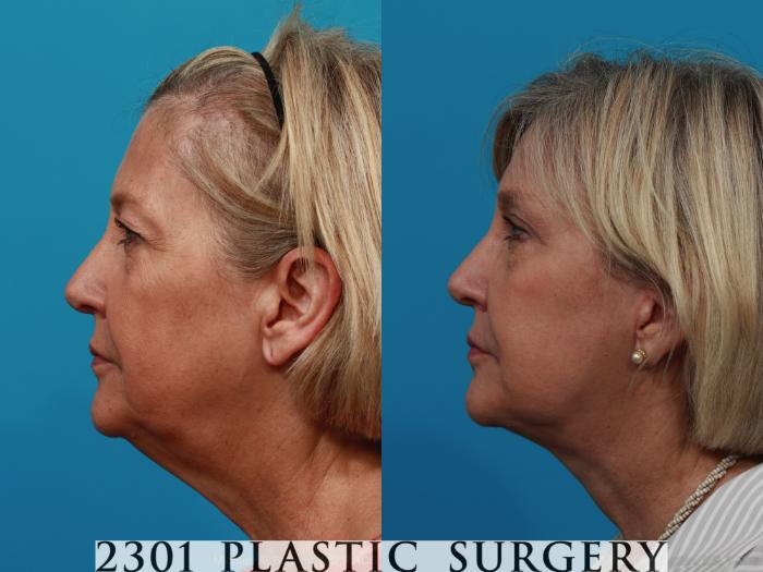 Before & After Face Lift Case 260 View #2 View in Fort Worth, Plano, & Frisco, Texas