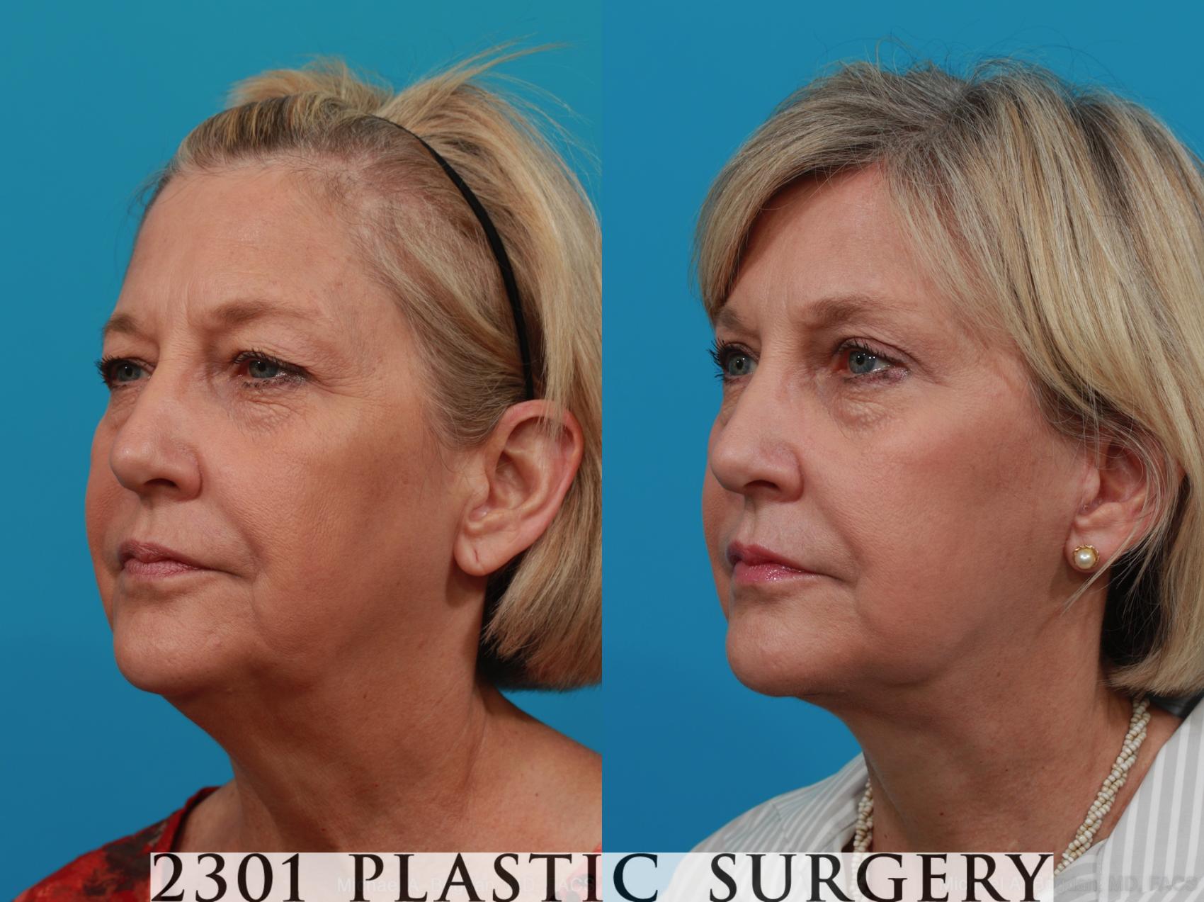 Before & After Blepharoplasty Case 260 View #3 View in Fort Worth & Frisco, Texas