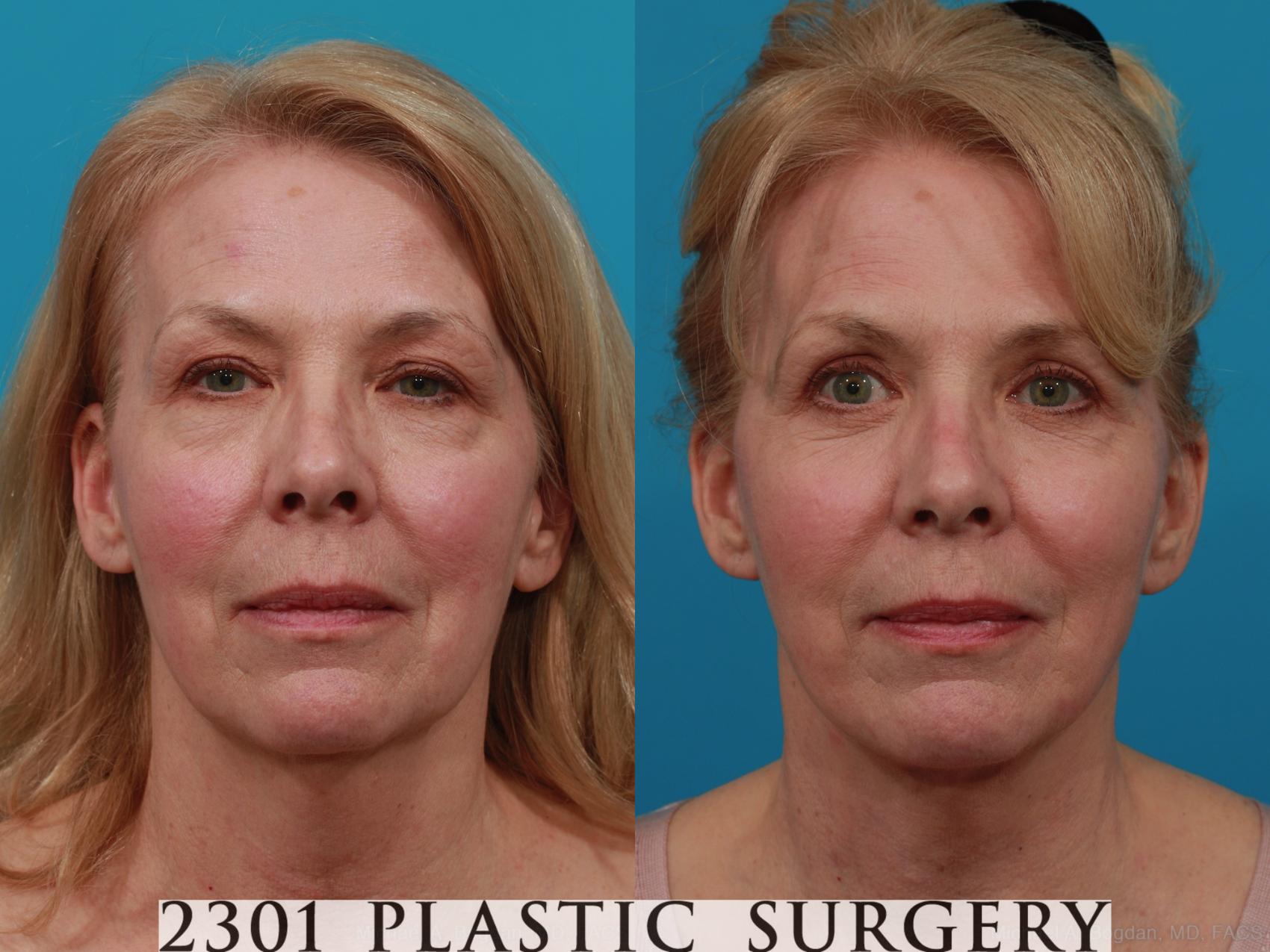 Before & After Face Lift Case 276 View #1 View in Fort Worth & Frisco, Texas