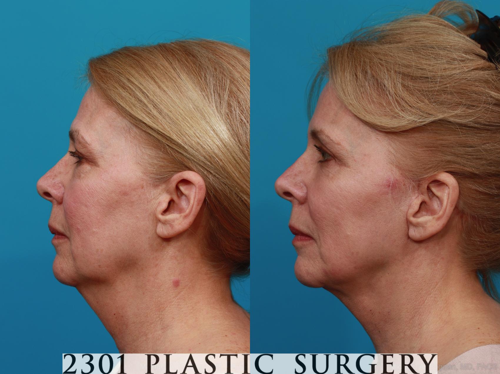 Before & After Face Lift Case 276 View #2 View in Fort Worth & Frisco, Texas