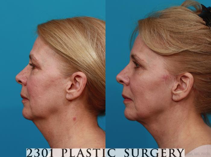 Before & After Blepharoplasty Case 276 View #2 View in Fort Worth & Frisco, Texas