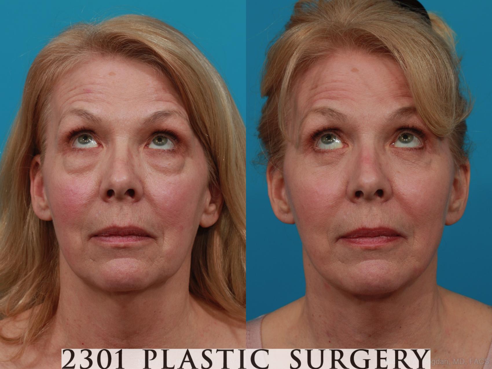 Before & After Face Lift Case 276 View #3 View in Fort Worth & Frisco, Texas