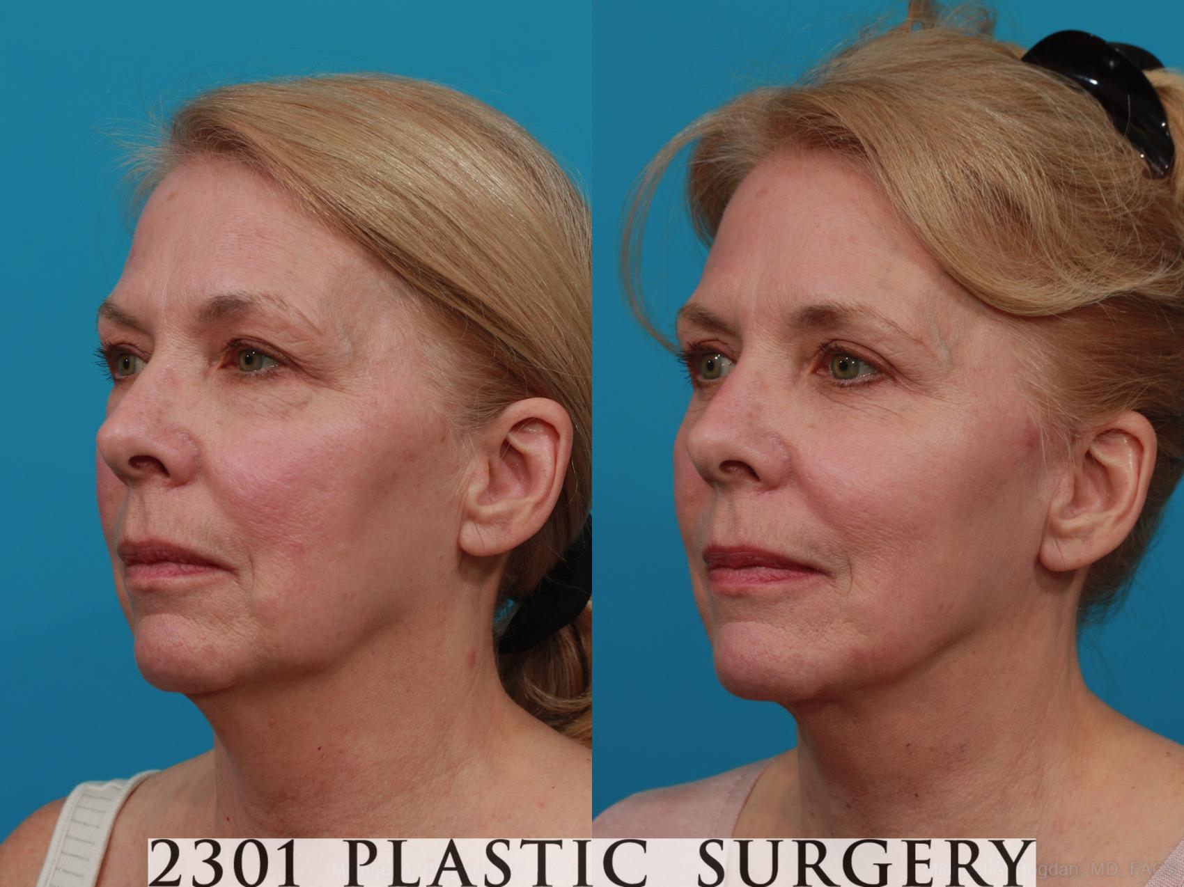 Before & After Face Lift Case 276 View #4 View in Fort Worth & Frisco, Texas