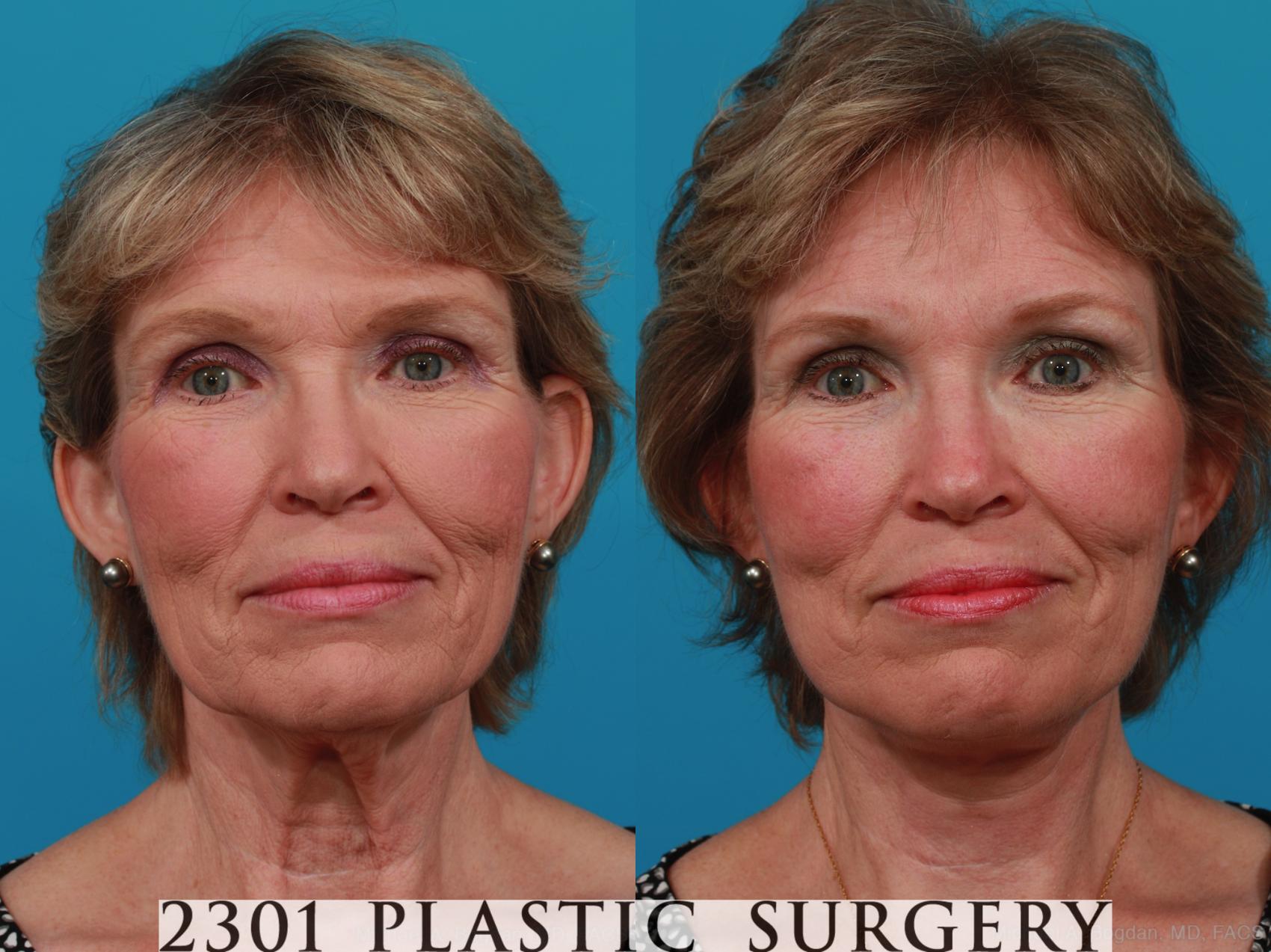 Before & After Face Lift Case 313 View #1 View in Fort Worth, Plano, & Frisco, Texas