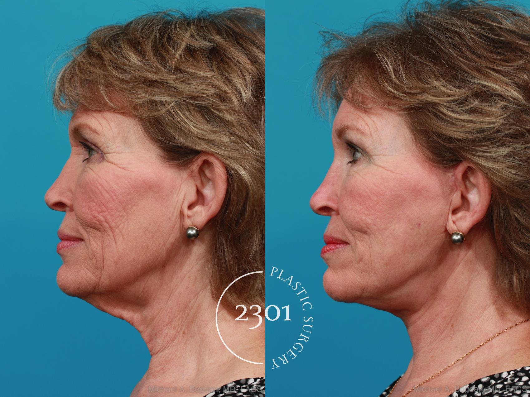 Before & After Face Lift Case 313 View #2 View in Fort Worth, Plano, & Frisco, Texas
