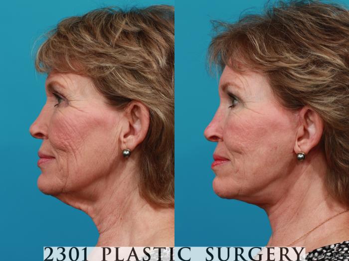 Before & After Face Lift Case 313 View #2 View in Fort Worth, Plano, & Frisco, Texas