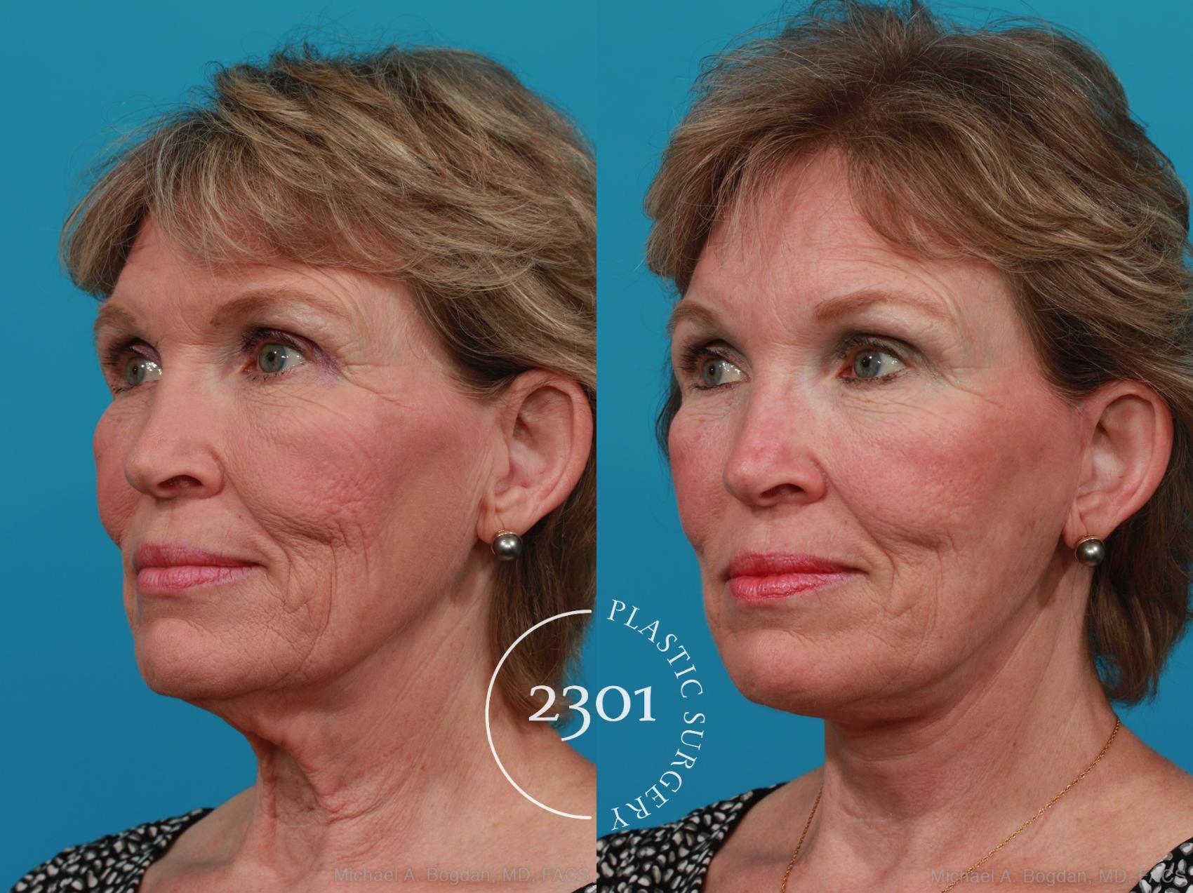 Before & After Face Lift Case 313 View #3 View in Fort Worth, Plano, & Frisco, Texas