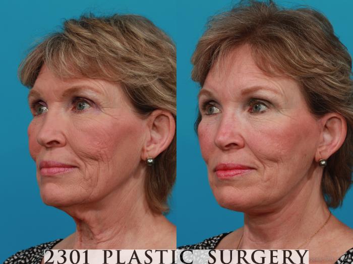 Before & After Face Lift Case 313 View #3 View in Fort Worth, Plano, & Frisco, Texas