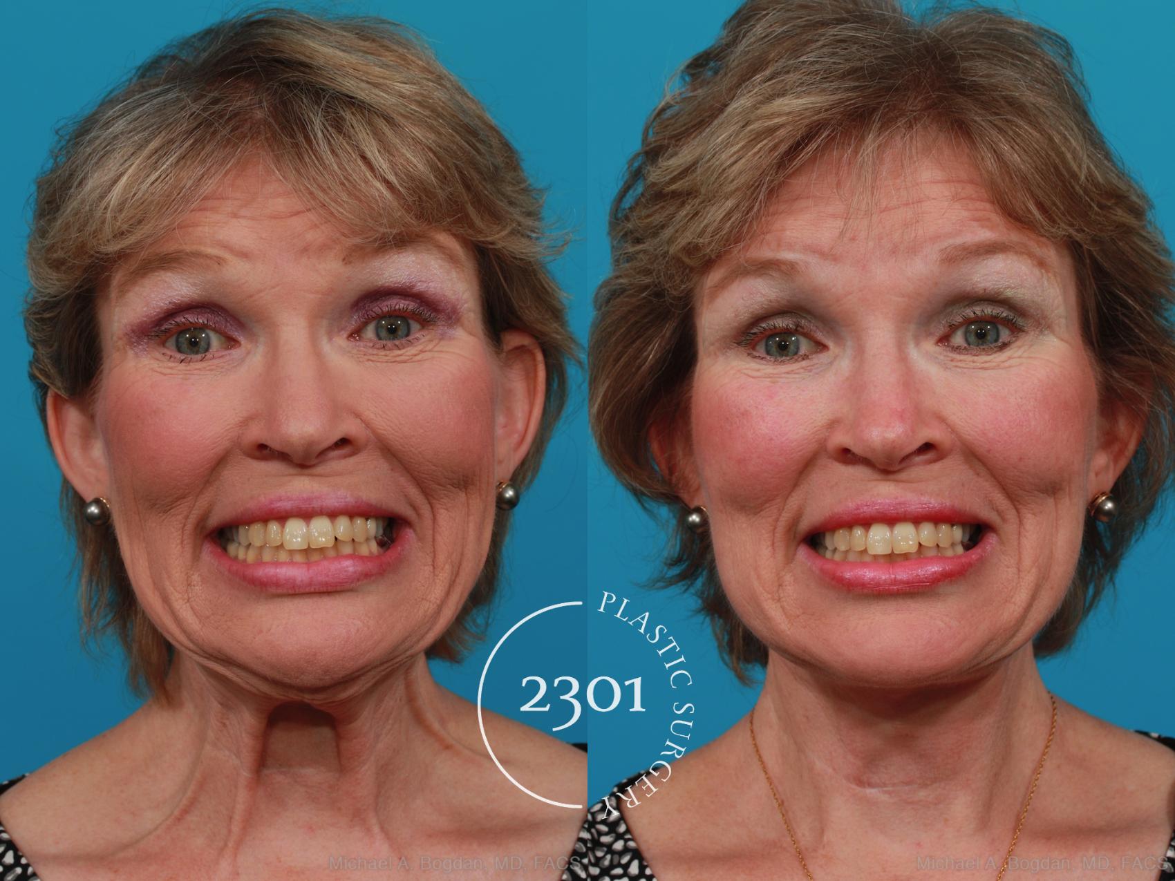 Before & After Face Lift Case 313 View #4 View in Fort Worth, Plano, & Frisco, Texas