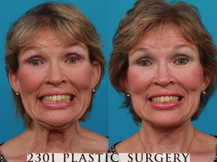 Before & After Face Lift Case 313 View #4 View in Fort Worth, Plano, & Frisco, Texas
