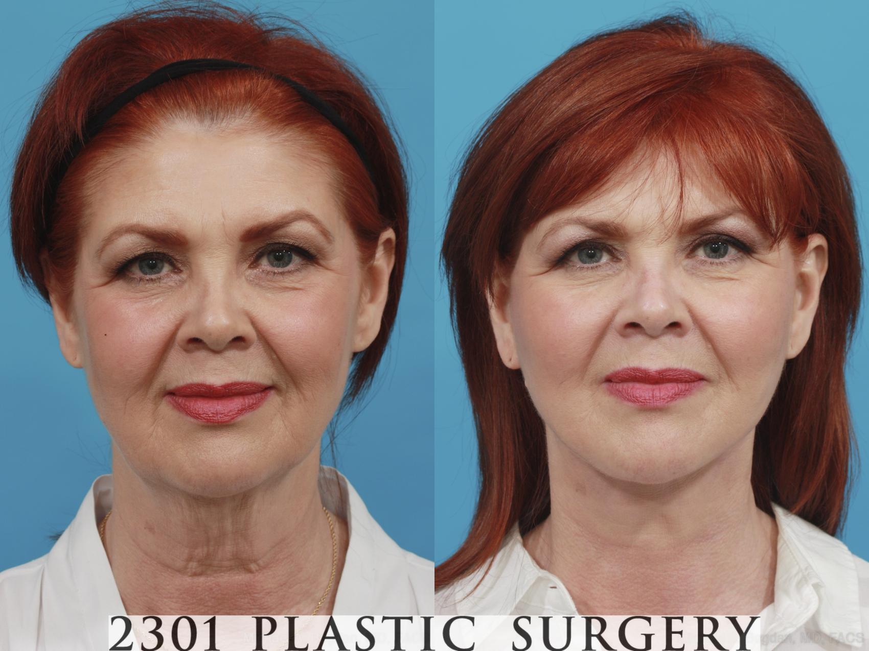 Before & After Face Lift Case 416 View #1 View in Fort Worth, Plano, & Frisco, Texas