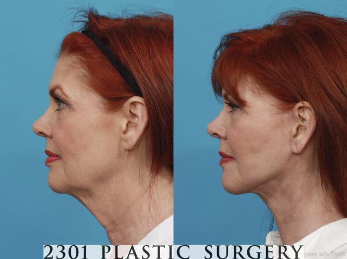 Before & After Face Lift Case 416 View #2 View in Fort Worth, Plano, & Frisco, Texas