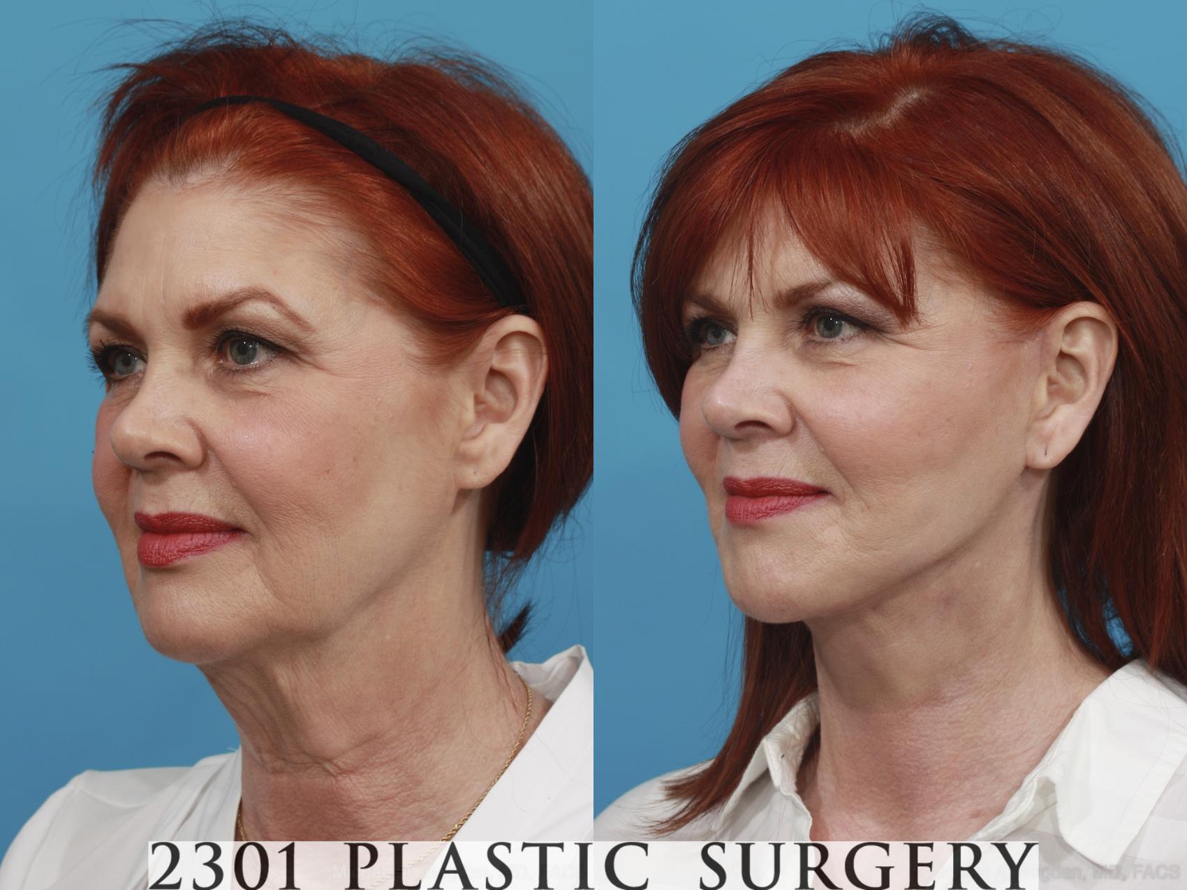 Before & After Face Lift Case 416 View #3 View in Fort Worth & Frisco, Texas