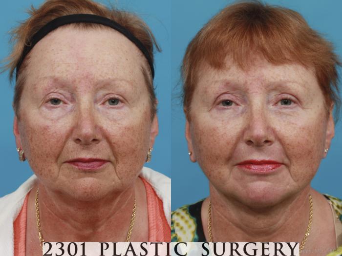 Before & After Face Lift Case 419 View #1 View in Fort Worth, Plano, & Frisco, Texas