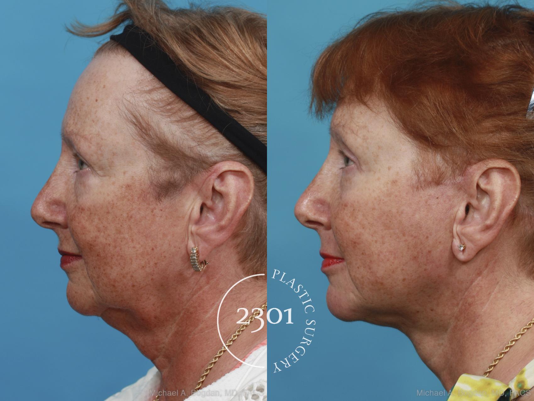 Before & After Face Lift Case 419 View #2 View in Fort Worth, Plano, & Frisco, Texas