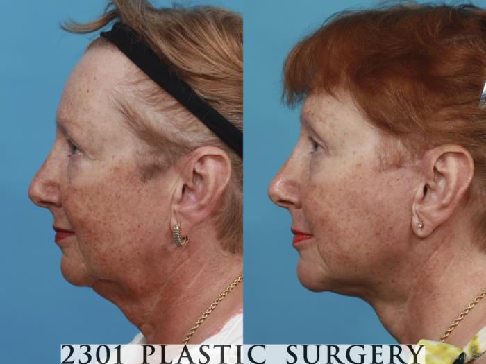 Before & After Face Lift Case 419 View #2 View in Fort Worth, Plano, & Frisco, Texas