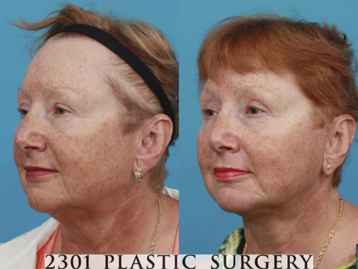 Before & After Face Lift Case 419 View #3 View in Fort Worth, Plano, & Frisco, Texas