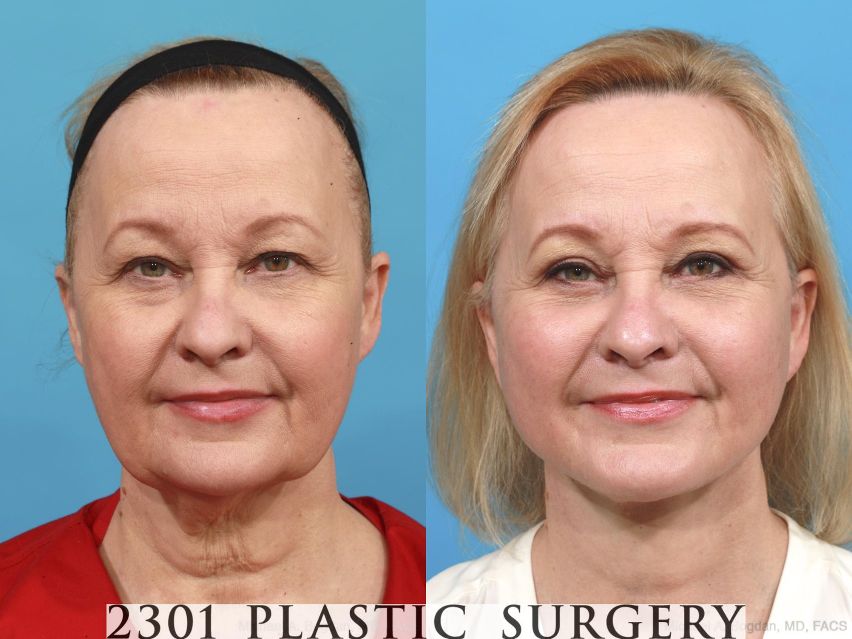 Before & After Face Lift Case 475 View #1 View in Fort Worth & Frisco, Texas