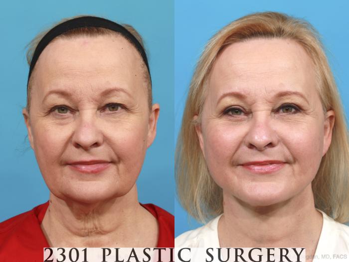 Before & After Neck Lift Case 475 View #1 View in Fort Worth & Frisco, Texas