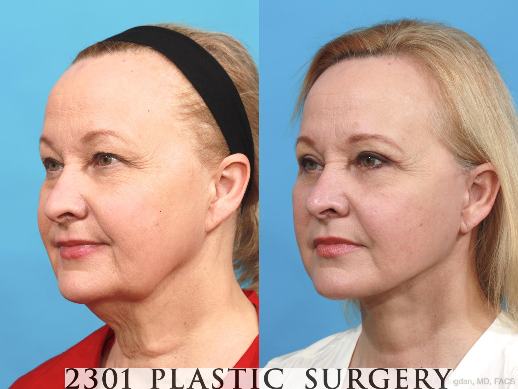 Before & After Face Lift Case 475 View #2 View in Fort Worth & Frisco, Texas