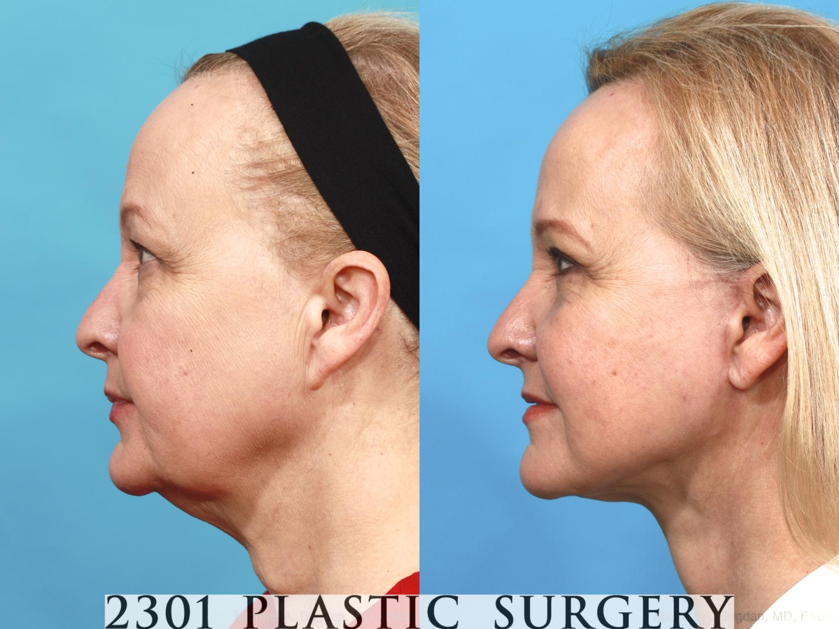Before & After Face Lift Case 475 View #3 View in Fort Worth & Frisco, Texas