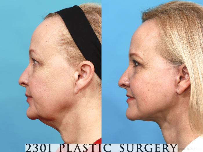 Before & After Face Lift Case 475 View #3 View in Fort Worth, Plano, & Frisco, Texas