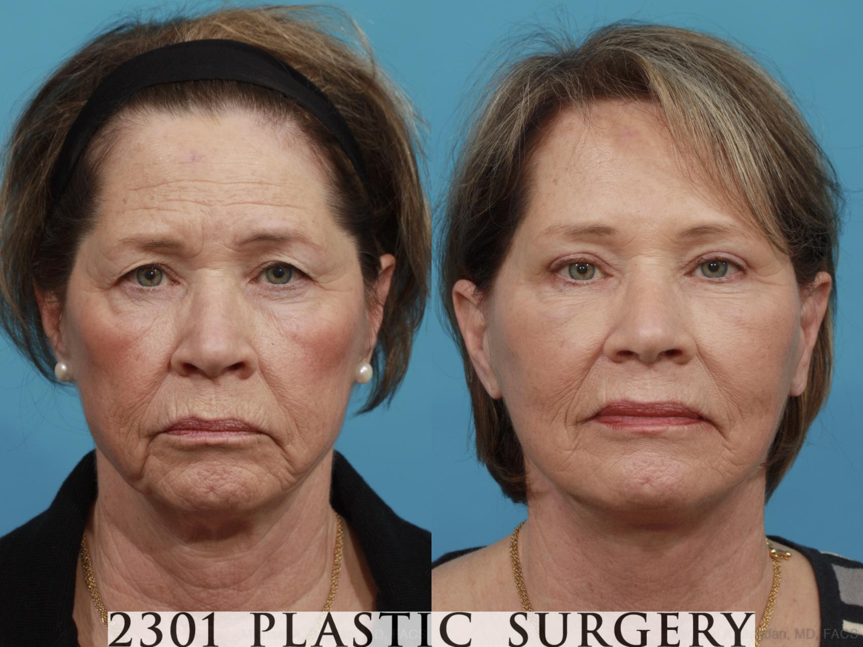 Before & After Face Lift Case 477 View #1 View in Fort Worth, Plano, & Frisco, Texas