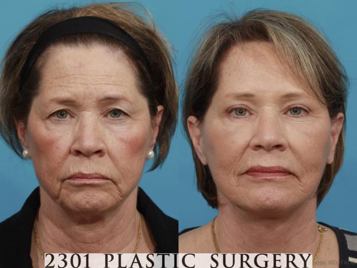 Before & After Face Lift Case 477 View #1 View in Fort Worth & Frisco, Texas
