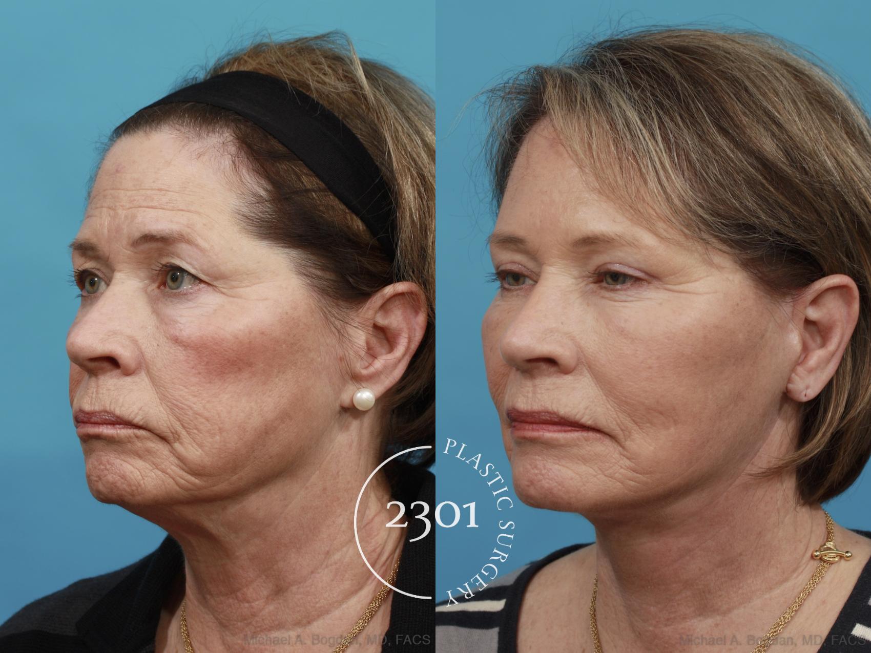 Before & After Face Lift Case 477 View #2 View in Fort Worth, Plano, & Frisco, Texas