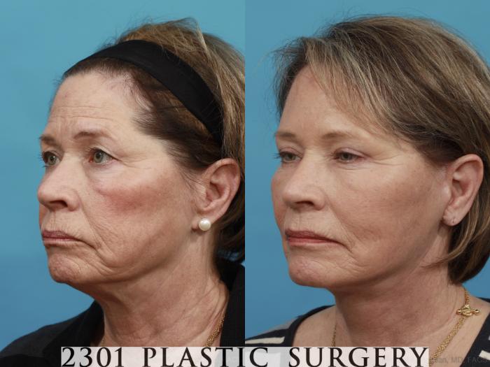 Before & After Face Lift Case 477 View #2 View in Fort Worth, Plano, & Frisco, Texas